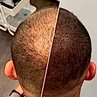 Трихопигментация